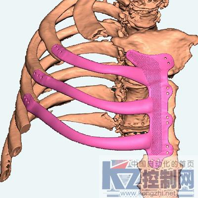 肋骨植入体.jpg